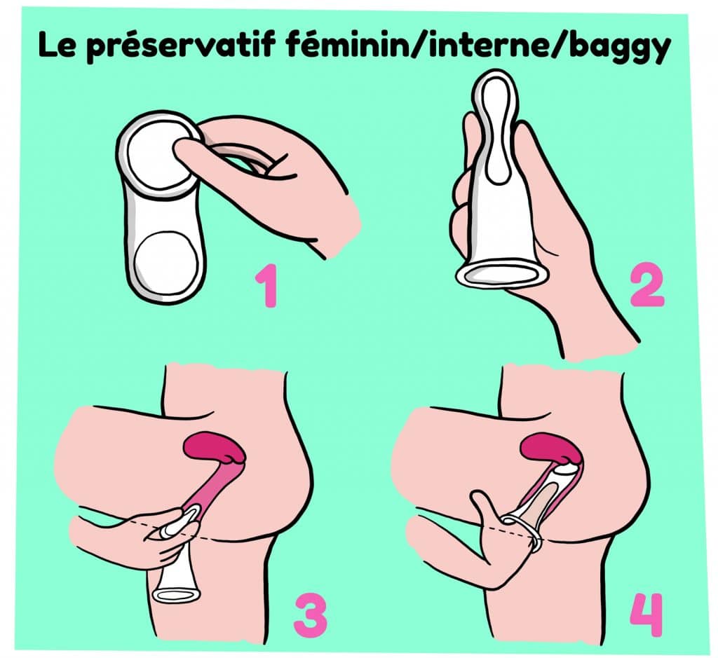 Preservatif feminin, illustration pour savoir comment le mettre