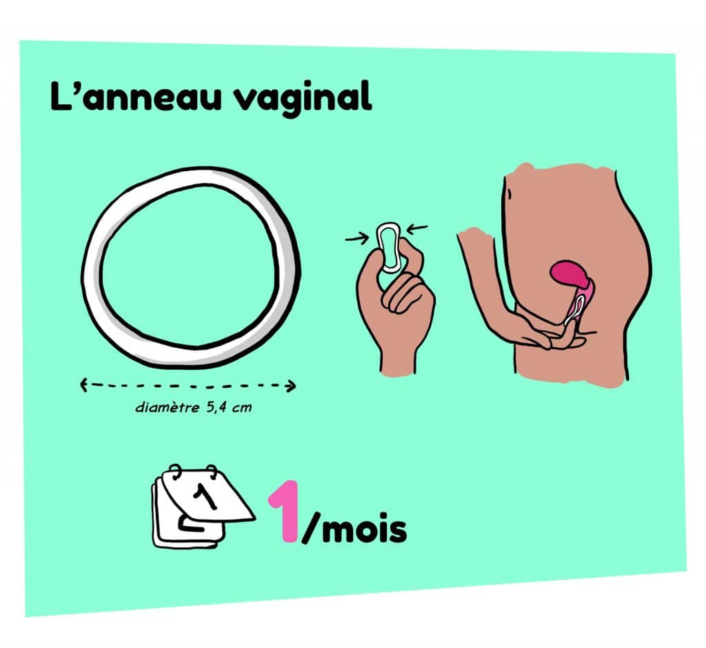 Illustration d'un anneau vaginal, contraception feminine