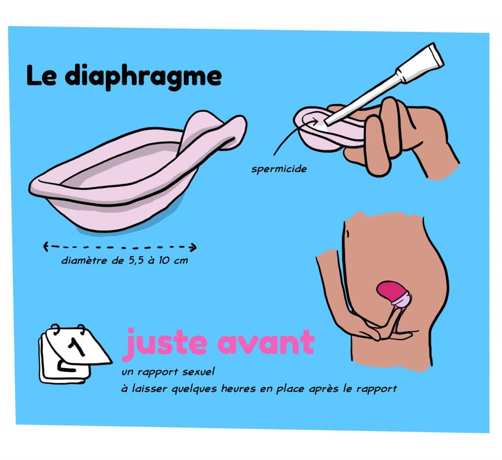 Le diaphragme contraception pour femmes, illustration pour le mettre