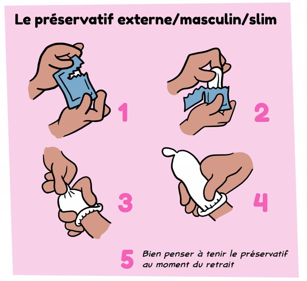 Preservatif masculin, illustration pour savoir comment le mettre